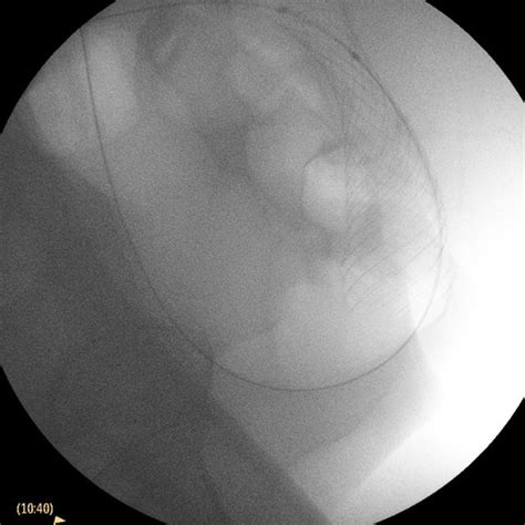 Post procedure X-ray colonic stent (sigmoid colon). | Download Scientific Diagram