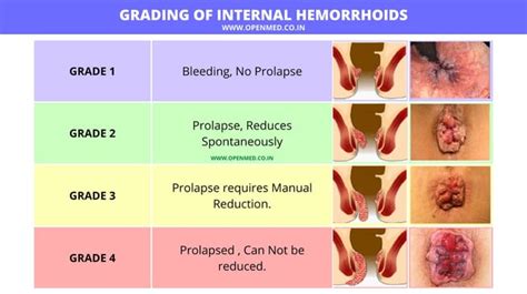 GRADING OF INTERNAL HEMORRHOIDS : r/surgery