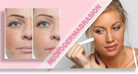 Home Microdermabrasion | Reduce Face Wrinkles- DIY Rejuvenation!