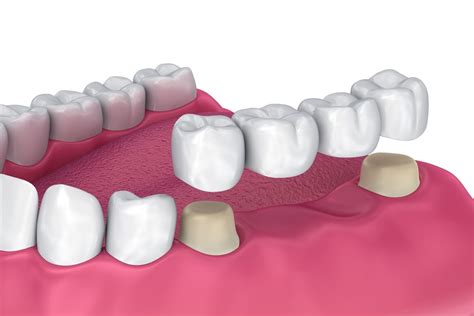 Los Beneficios De Las Prótesis Dentales Fijas - City Dental