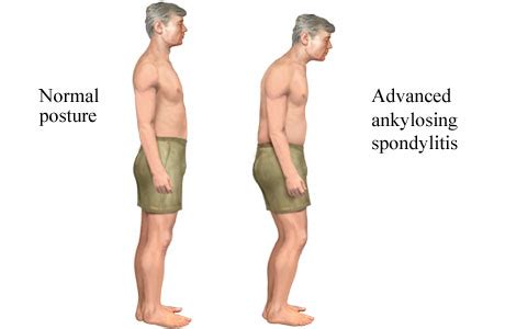 Ankylosing Spondylitis Causes, Symptoms, Diagnosis and Treatment - Natural Health News