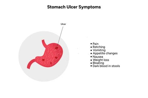 Premium Vector | Stomach Ulcer symptoms peptic ulcer