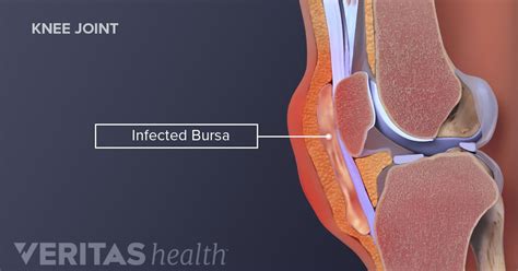 Prepatellar Bursitis Symptoms