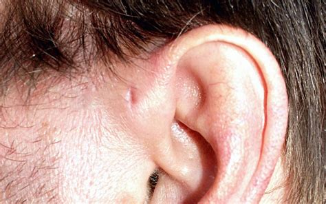 Agujero en la oreja (fosa preauricular): lo que debe saber - Salud - Tudo