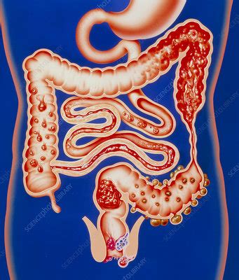 Artwork showing a range of intestinal diseases. - Stock Image - M130 ...