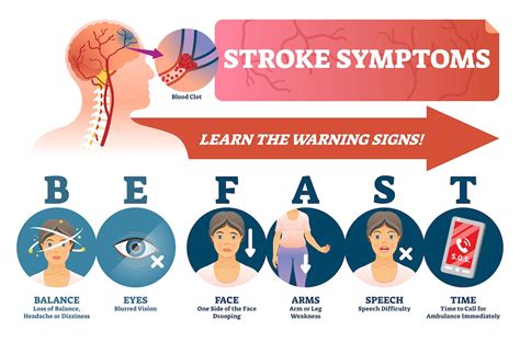 Stroke Symptoms Causes Warning Signs And Types Pacific Stroke | My XXX ...