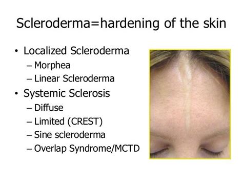 Skin Manifestations of Scleroderma, by Dr. Lorinda Chung MD