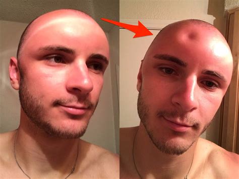 Photos of a man's sunburned head are going viral - Business Insider