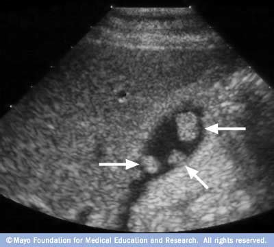 Gallbladder polyps - Mayo Clinic