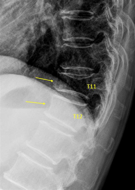 Vertebra T11 and T12 OVD. T11 measured 33% height loss (GSQ: grade-2 ...