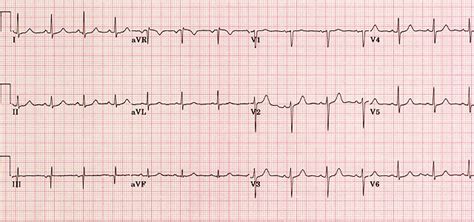 ECG (EKG) examples and quiz - Oxford Medical Education