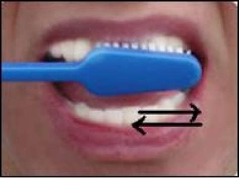 Figure 3 from Causes laceration of the gingiva 2 ) Modified Bass Method / Sulcus Cleaning Method ...