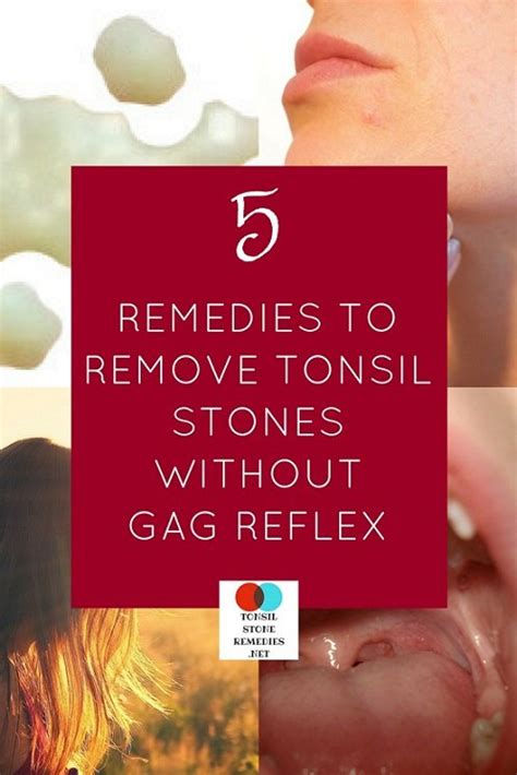 5 Home remedies that can easily remove tonsil stones without any gag reflex