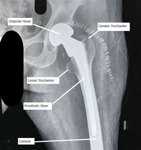 Total hip vs hemiarthroplasty femoral neck fracture - equipmentlery