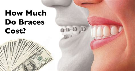 How Much Do Braces Cost? | Saddle Creek Orthodontics | Dr. Kyle