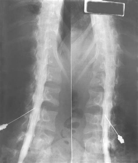 Myelogram | Bristol Spine Intervention