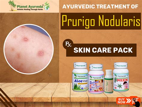 Treatment of Prurigo Nodularis with Ayurveda