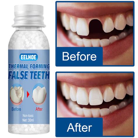 EELHOE temporary tooth repair teeth Temporary Restorative Denture Filling Solid Gel ...