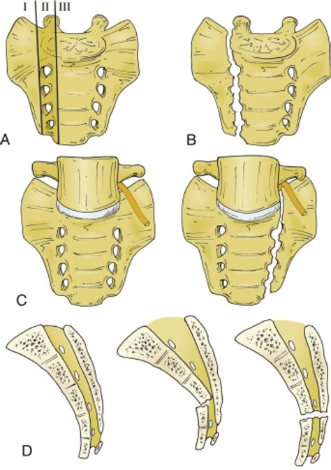 Sacral Fracture Classification