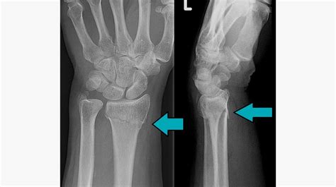 Scaphoid Fracture Cast Time