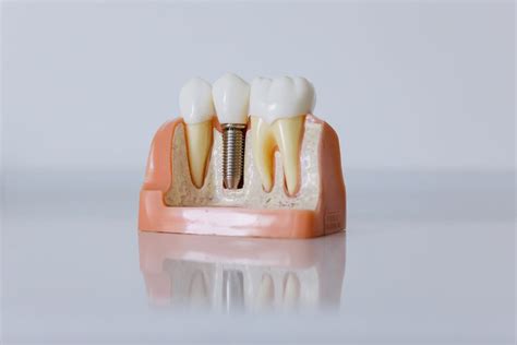 Dental Implants: Surgery, Advantages, and Risks - Park Avenue Dental