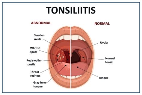 Tonsillitis: Causes, Symptoms, Diagnosis, Treatment, Risk | Medicover Hospitals
