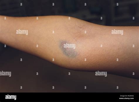 Bruise Arm High Resolution Stock Photography and Images - Alamy