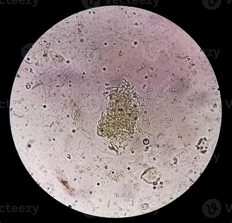 Microscopic image showing Calcium oxalate crystal and others urinary crystals from urine ...