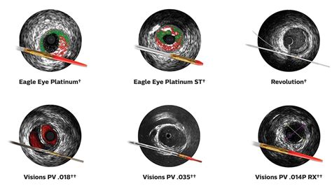 Intravascular Ultrasound (IVUS) | Philips Healthcare