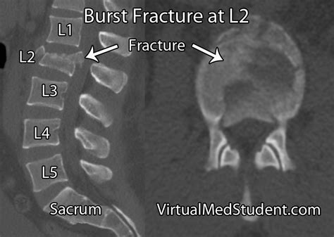 VirtualMedStudent.com || Thoracolumbar Burst Fractures