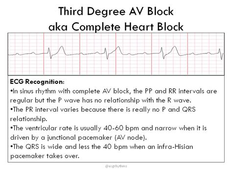 Third Degree AV Block aka Complete Heart Block • ... | GrepMed