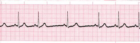 Level 2 - 11 - 20 - ECG - Memrise