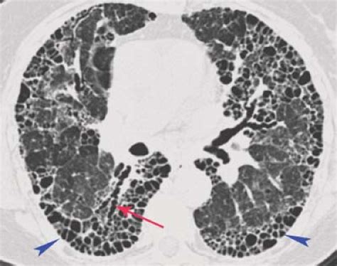 Diffuse Lung Disease | Radiology Key