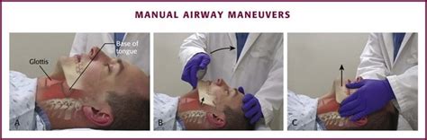 Basic Airway Management and Decision Making | Clinical Gate