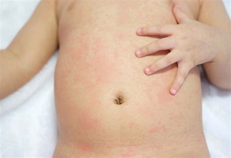 Zika Virus Infections in Babies & Kids: Symptoms, Treatment and Prevention