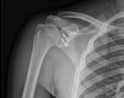 Midlands Orthopaedics | Shoulder Surgery