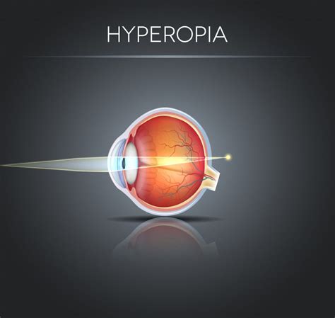 Hyperopia, vision disorder | Moran Eye Associates