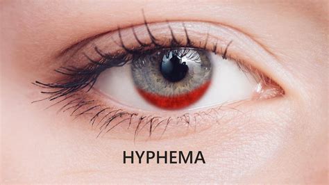 What’s Hyphema and its causes, treatment and symptoms?