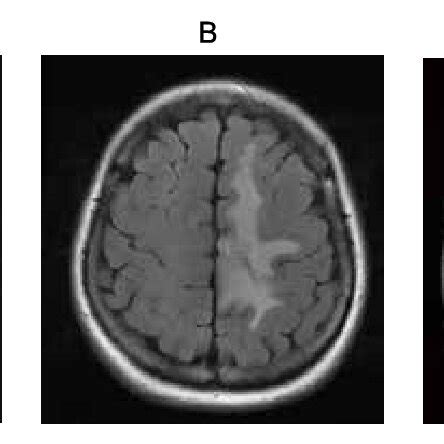 Brain MRI at initial presentation showed a left cingulate tumor ...