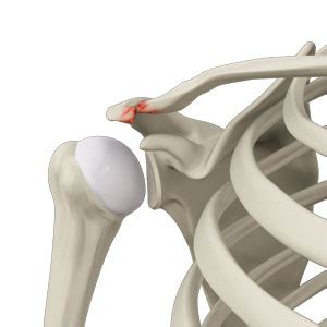 Acromioclavicular (AC) Arthritis | Advanced Orthopaedics & Sports ...