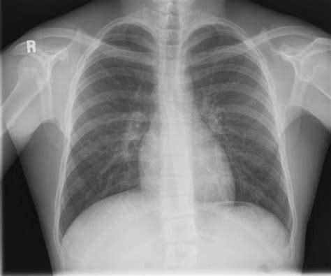 Radiological Anatomy: Lungs - Stepwards