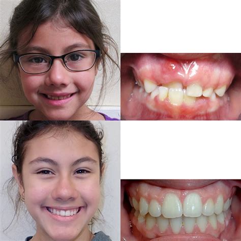 Before & After Braces | Wazio Orthodontics