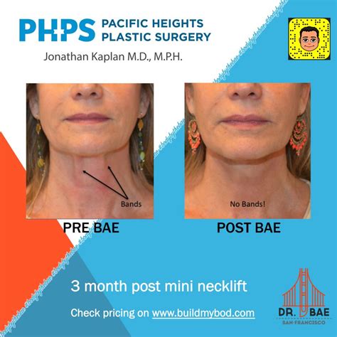 Neck Lift Surgery - Single Incision SIMI® - San Francisco | Plastic ...