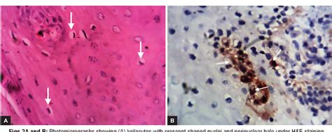 Figure 2 from Koilocytes in Oral Pathologies | Semantic Scholar