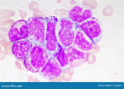 Chronic Myeloid Leukemia CML. Red Blood Cell. Blood Smear Royalty-Free Stock Photography ...
