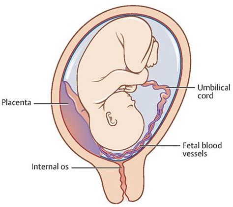 Vasa previa definition, causes, symptoms, diagnosis, ultrasound ...