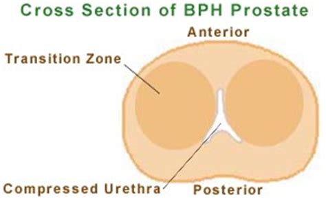 About enlarged prostate, enlarged prostate symptom, enlarged prostate treatment, enlarged ...