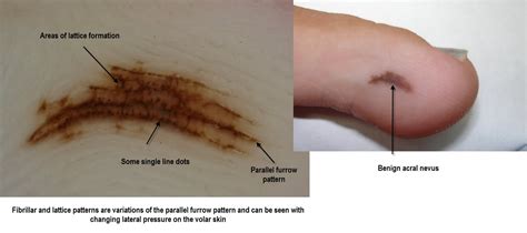 Dermoscopy Made Simple: Acral nevus