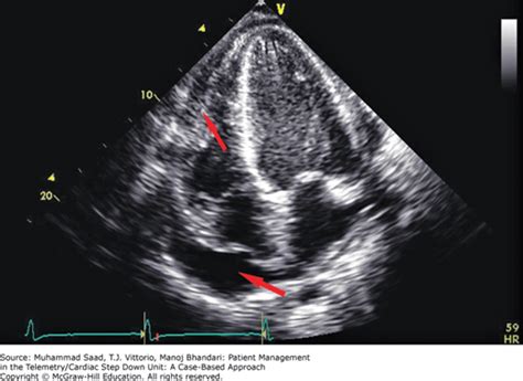 Abnormal Echocardiogram Results