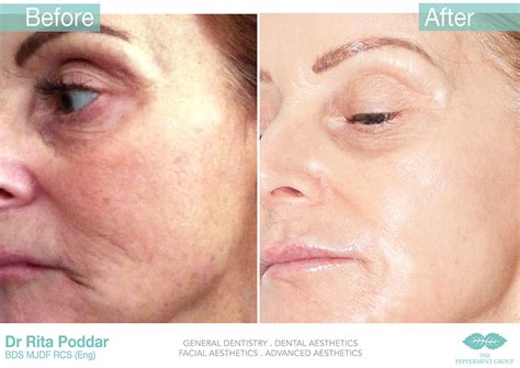 Acne & Rosacea Treatment Glasgow | ZO Skin Care Service